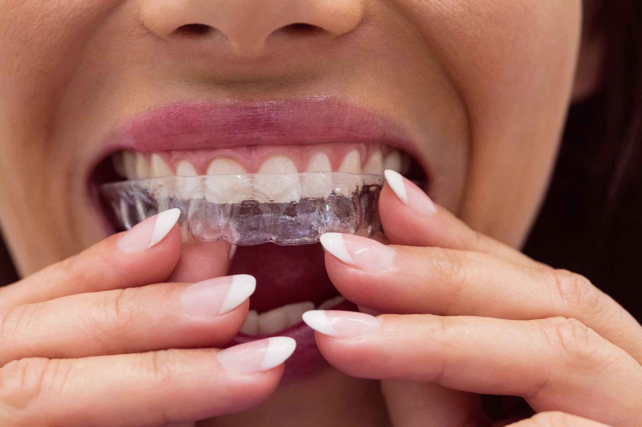 Onzichtbare beugel (aligners)